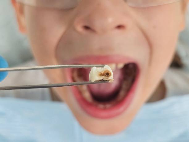 Best Emergency Dentist for Lost Fillings or Crowns in Hawaiian Beaches, HI